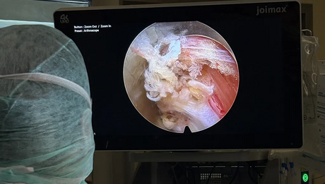 4K-Kameratechnik in der Wirbelsäulenchirurgie, medius KLINIK NÜRTINGEN
