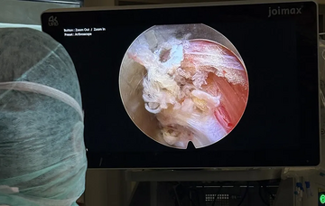 4K-Kameratechnik in der Wirbelsäulenchirurgie, medius KLINIK NÜRTINGEN