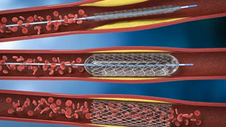 Periphere Arterielle Vershlusskrankheit