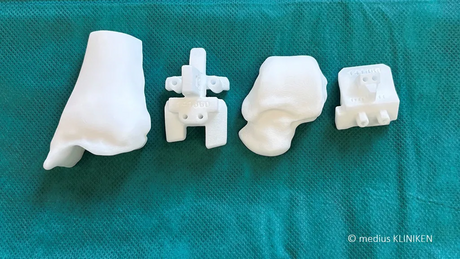 Fuss- und Sprunggelenkchirurgie, medius KLINIKEN, Implantate