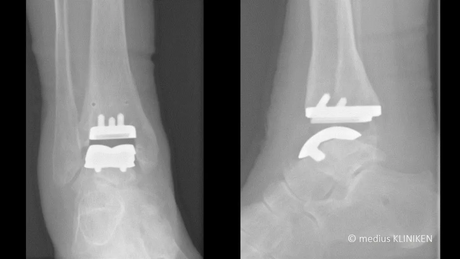 Fuss- und Sprunggelenkchirurgie, medius KLINIKEN, Röntgenbild Implantate